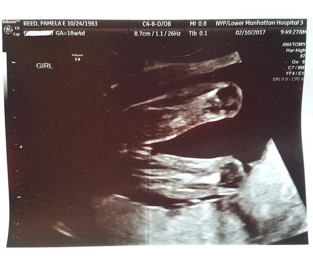 18 Weeks Pregnant With Girl, Ultrasound