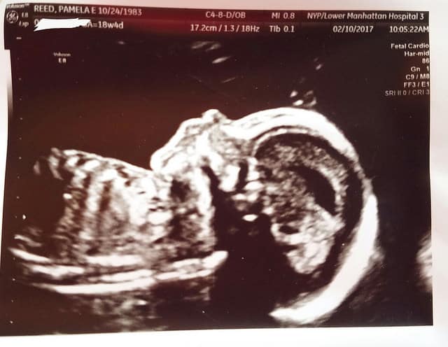 18 Weeks Pregnant Ultrasound 
